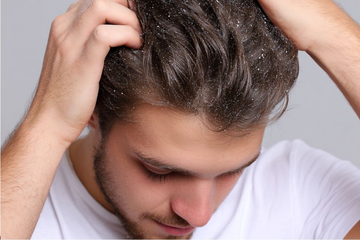 Dry Scalp or Dandruff? Experts Reveal the Key Signs to Know