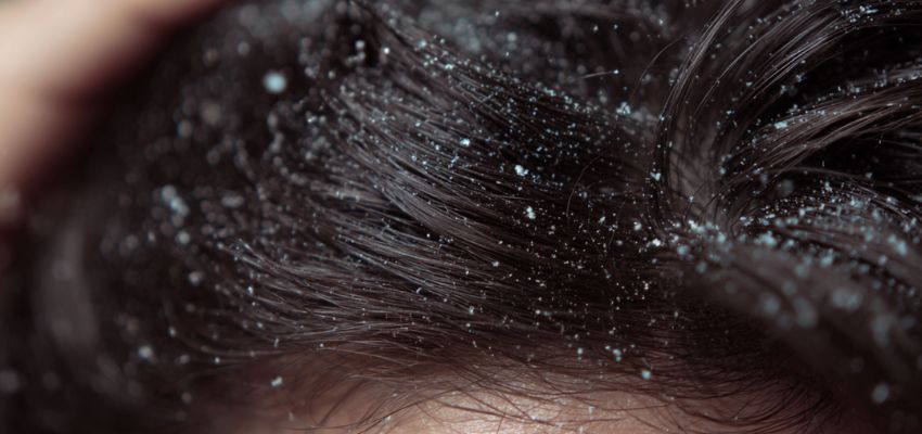 dry-scalp-vs-dandruff2 Close-up of hair roots showing dry scalp vs dandruff differences