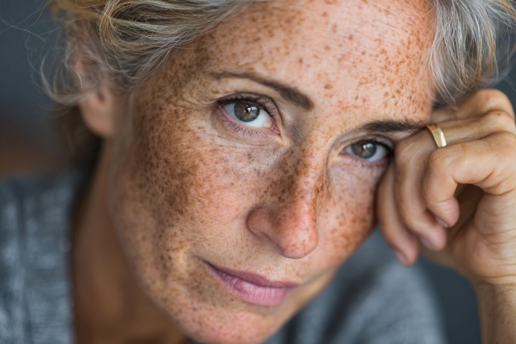 How to Remove Age Spots Naturally: Steps for Radiant Skin